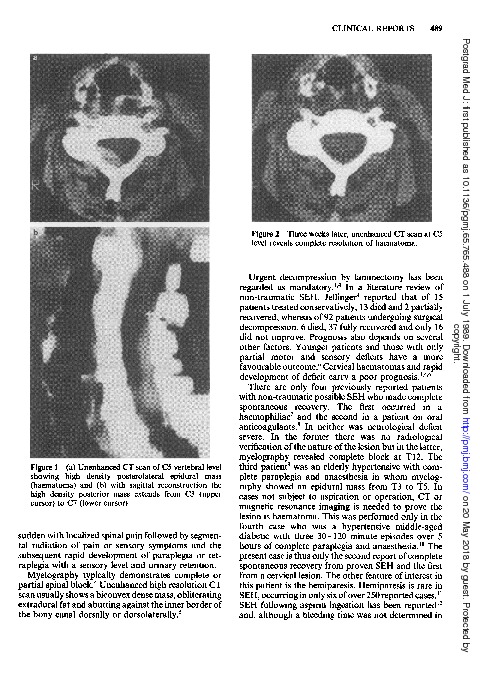 Download Spontaneous resolution of cervical spinal epidural haematoma.